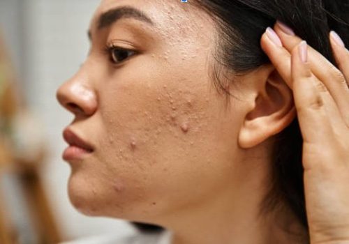 acne scarring treatment geelong