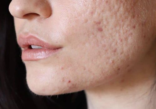 Professional acne treatment at Dermaluxe Beauty skin clinic