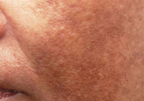 melasma_2_