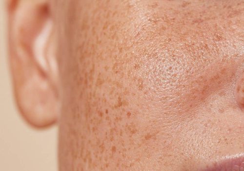 Pigmentation treatment at Dermaluxe Beauty Geelong West