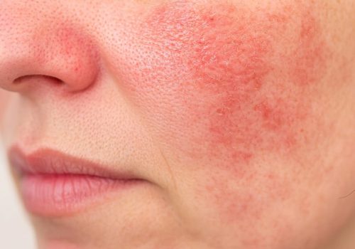 Rosacea treatment at Dermaluxe Beauty Geelong West