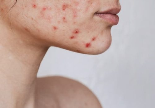 Advanced facial treatment for acne at Dermaluxe Beauty
